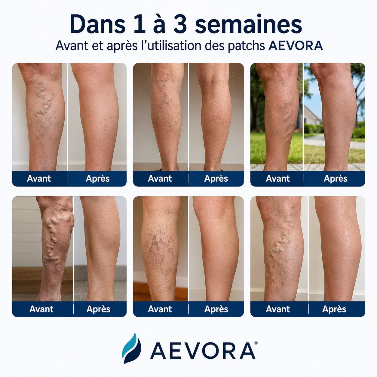 Application patch Aevora sur jambe - soulagement varices nuit